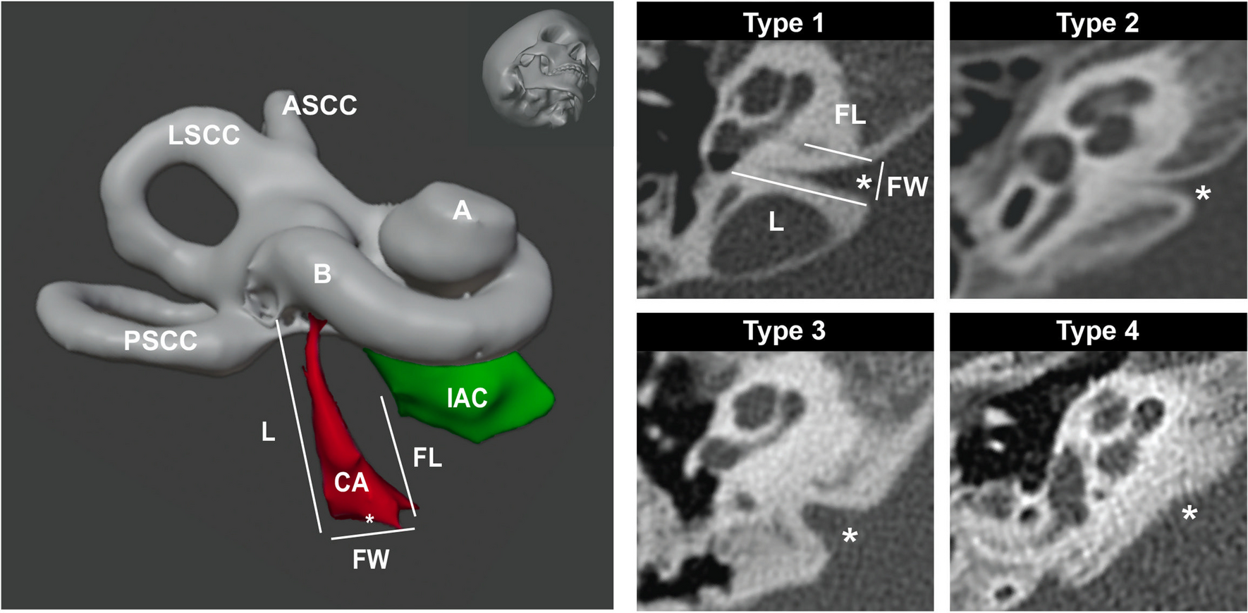 Cochlear Aqueduct Post-Natal Growth: A Computed Tomography Study