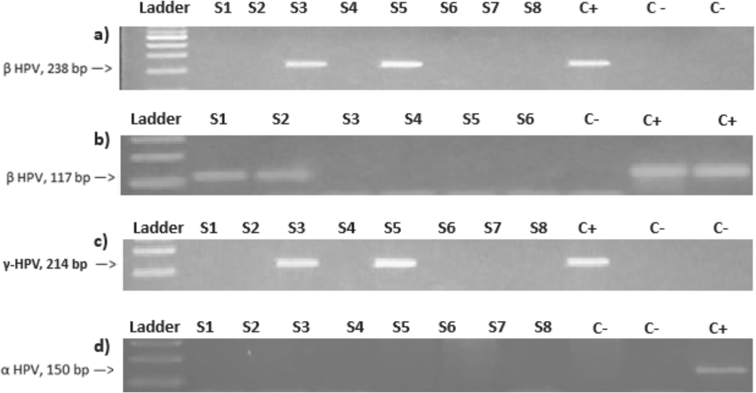 Human papillomaviruses in hand squamous cell carcinomas from Chilean patients
