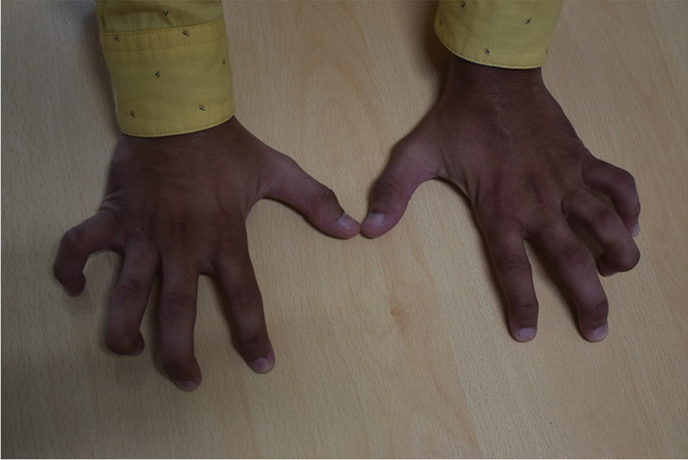 Severe limited joint mobility (LJM) involving both the hands and feet in type 1 diabetes mellitus