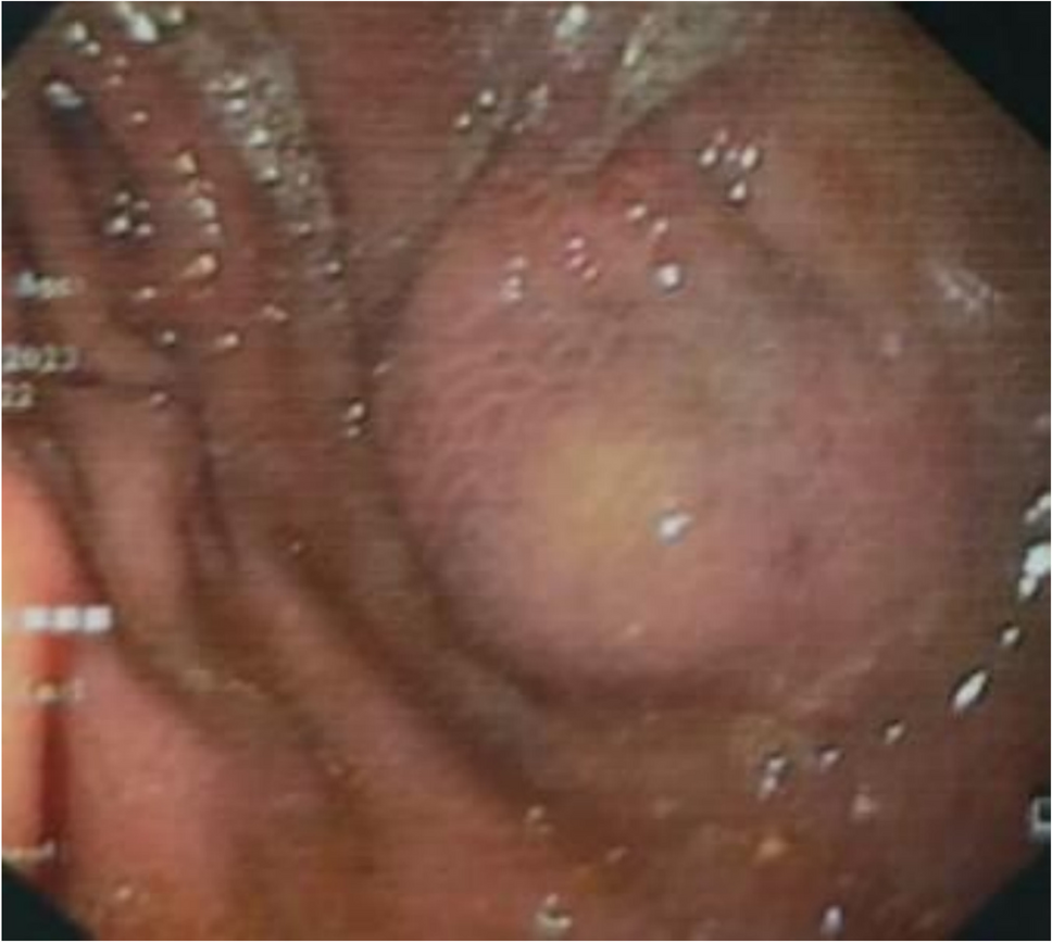 Gastric Xanthogranuloma: A Rare Mimicker of Gastrointestinal Stromal Tumor