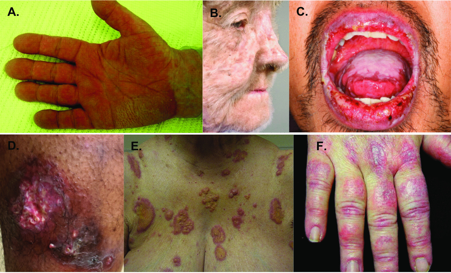 Cutaneous Signs of Internal Malignancy