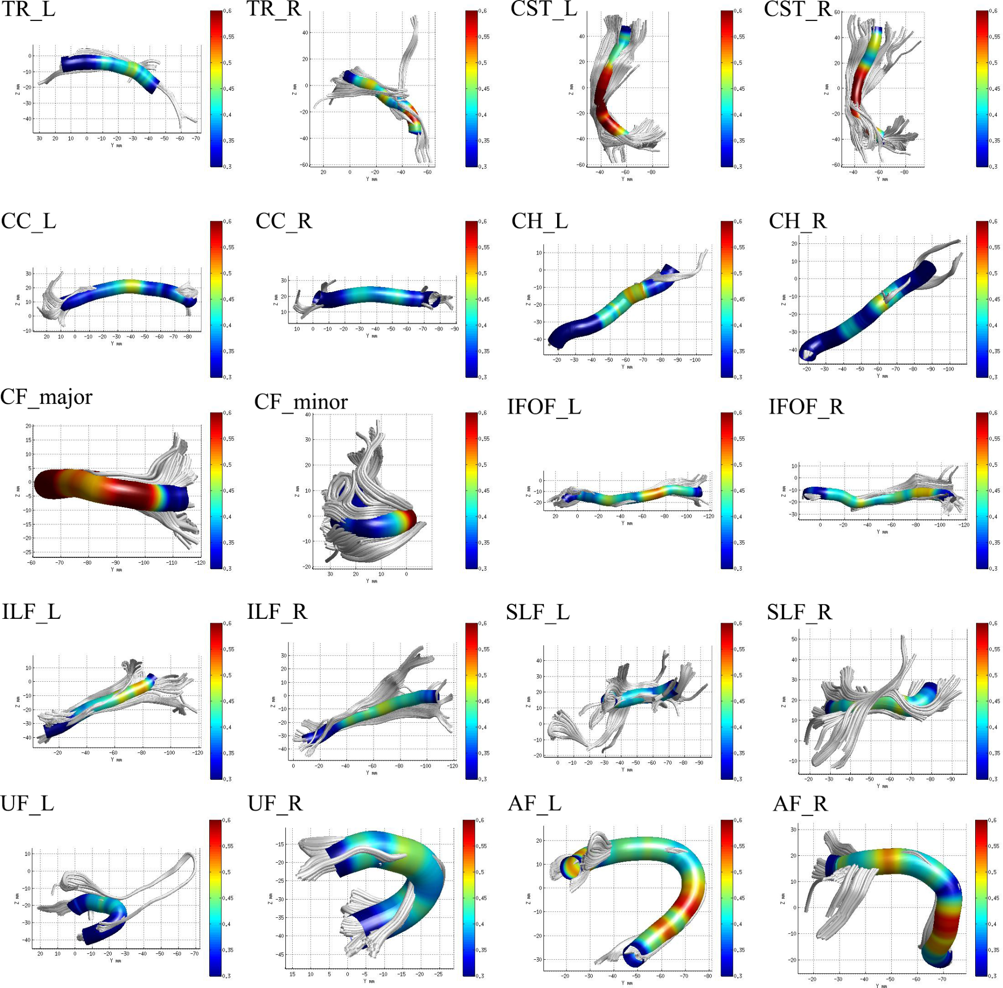 White matter microstructure damage measured by automated fiber quantification correlates with pain symptoms in lung cancer patients