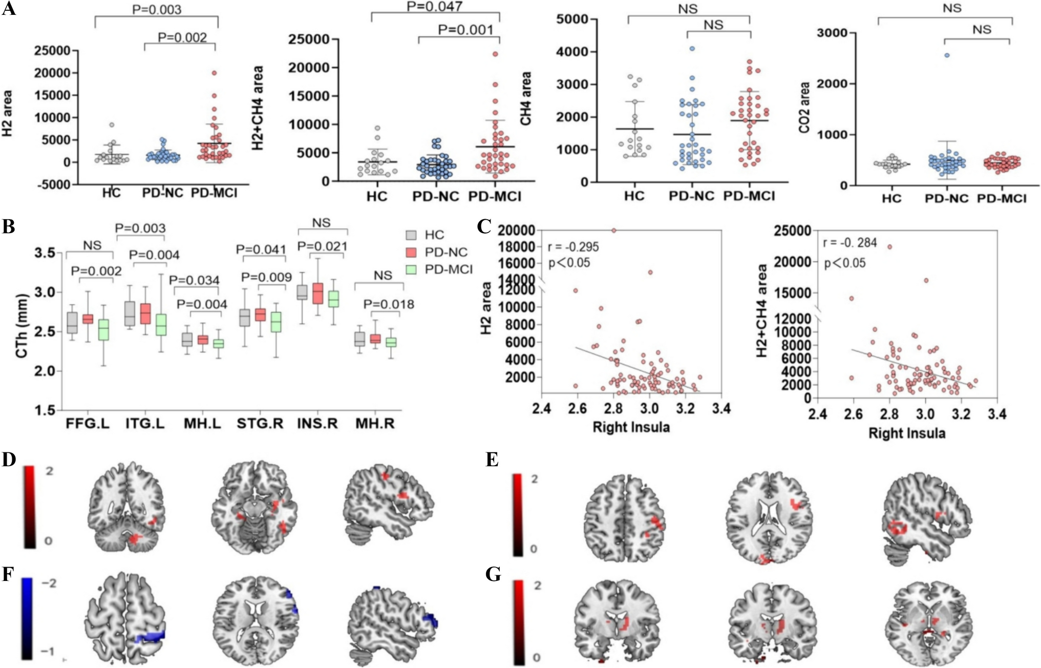Association of bacterial overgrowth in the small intestine with cortical thickness and functional connectivity in Parkinson's disease involving mild cognitive impairment