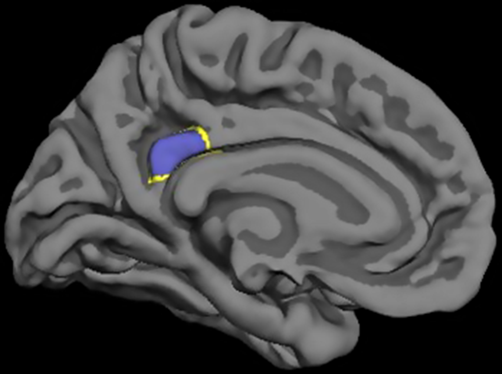 Metabolic syndrome is associated with reduced default mode network functional connectivity in young post-9/11 Veterans