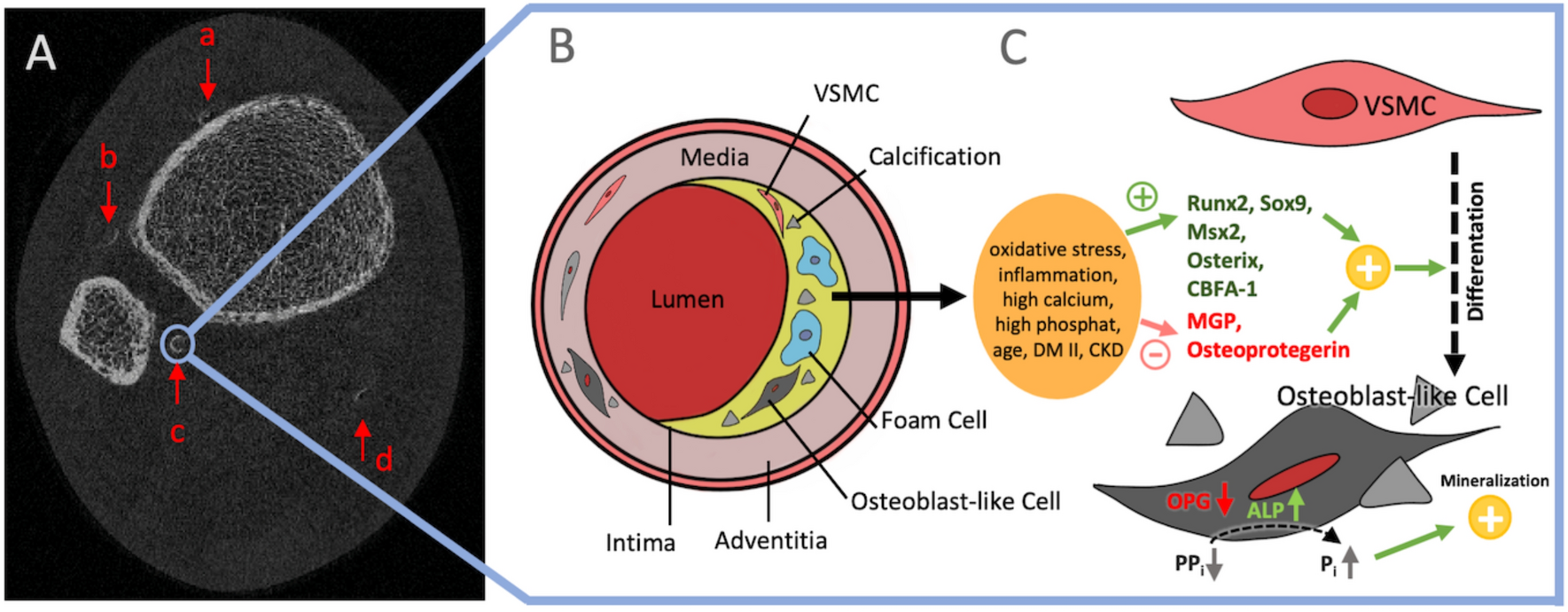 Sex-Specific Association Patterns of Bone Microstructure and Lower Leg Arterial Calcification
