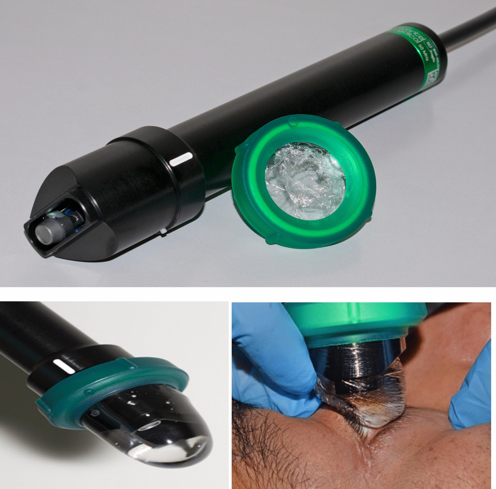 Evaluation of ciliary body cysts in candidates for phakic lens implantation