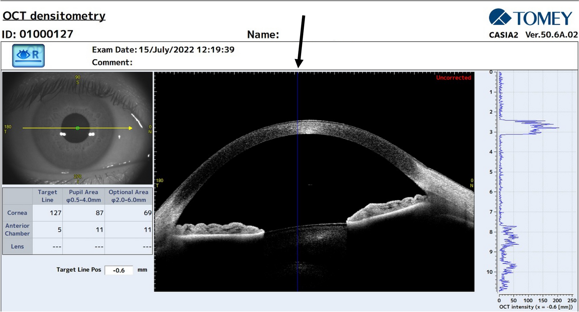 Corneal densitometry measurements comparison between anterior segment OCT and scheimpflug imaging