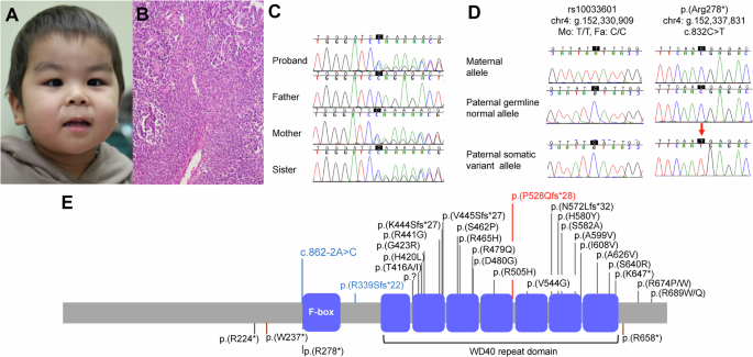 Two-hit mutation causes Wilms tumor in an individual with FBXW7-related neurodevelopmental syndrome