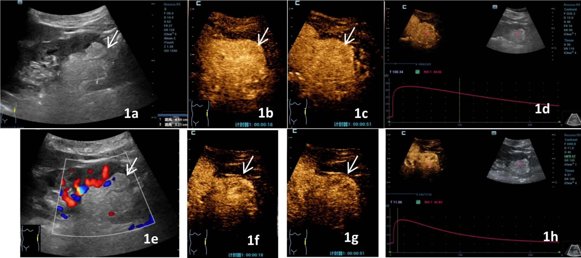 Qualitative and quantitative analysis of solid renal tumors by high-frame-rate contrast-enhanced ultrasound