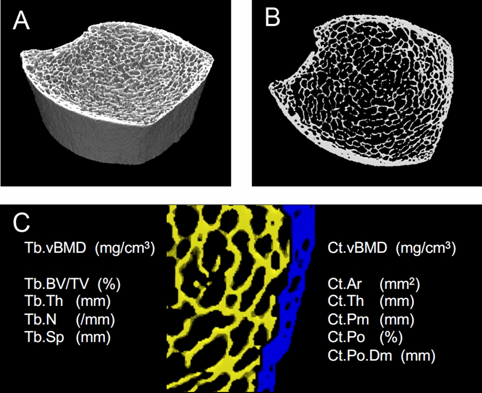 Chemotherapy effects on bone mineral density and microstructure in women with breast cancer