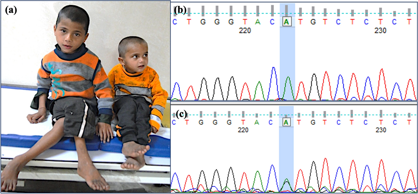COQ7 splice site variant causing a spastic paraparesis phenotype in siblings