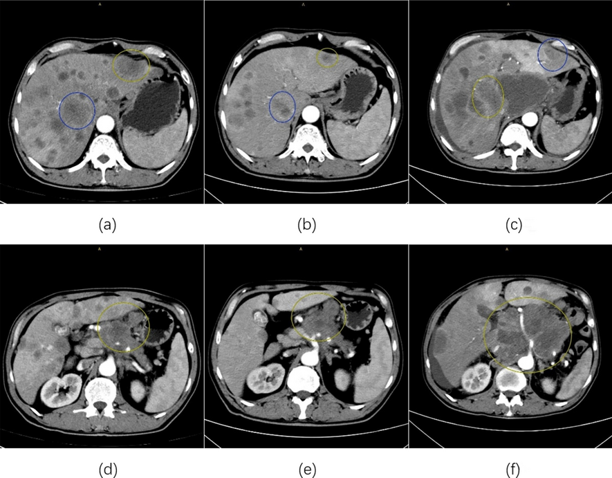 First reported advanced pancreatic cancer with hyperprogression treated with PD-1 blockade combined with chemotherapy: a case report and literature review