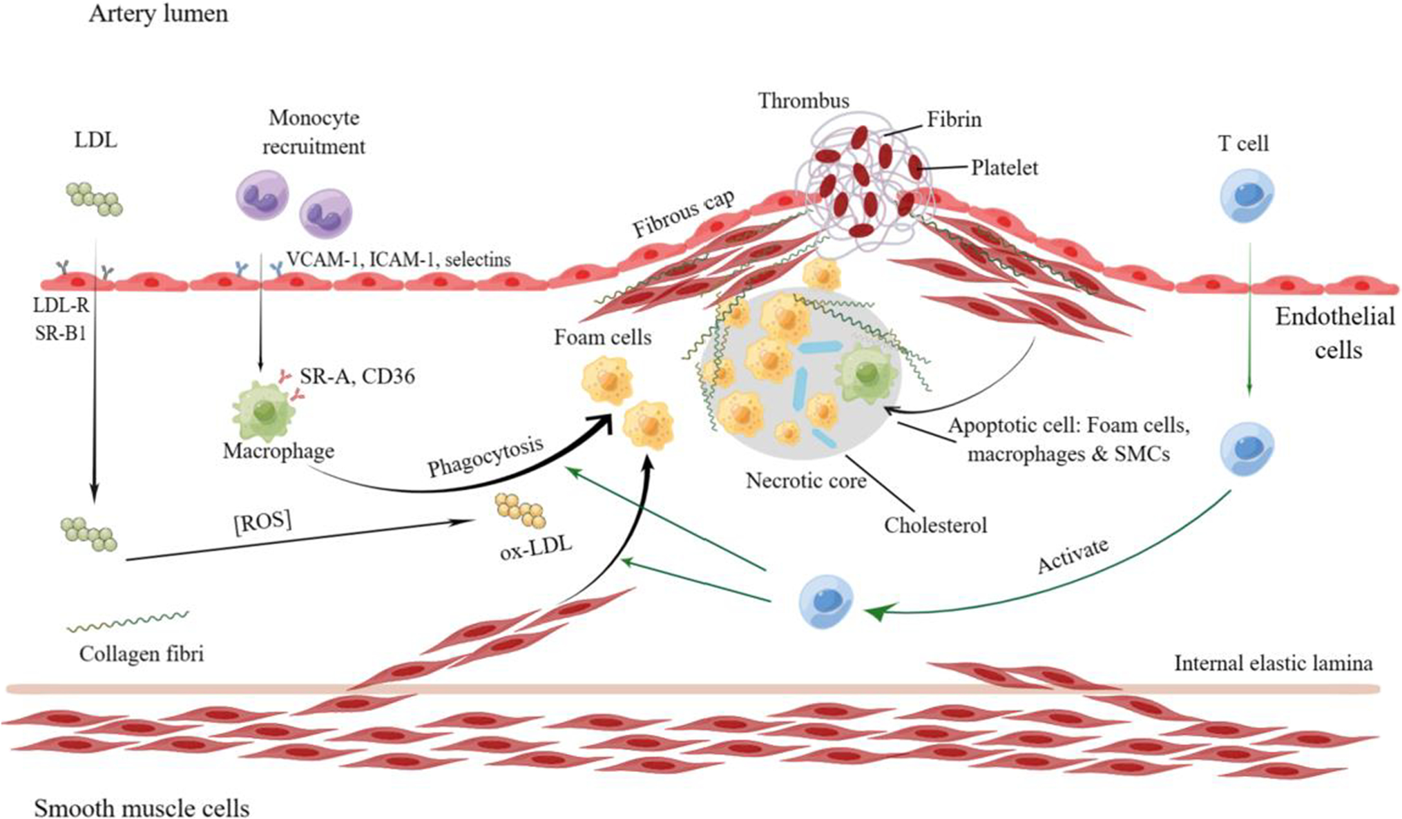 Research progress on the therapeutic effects of nanoparticles loaded with drugs against atherosclerosis