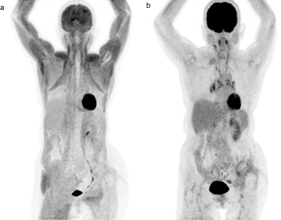 Clinical scenarios of unusual FDG uptake in muscle