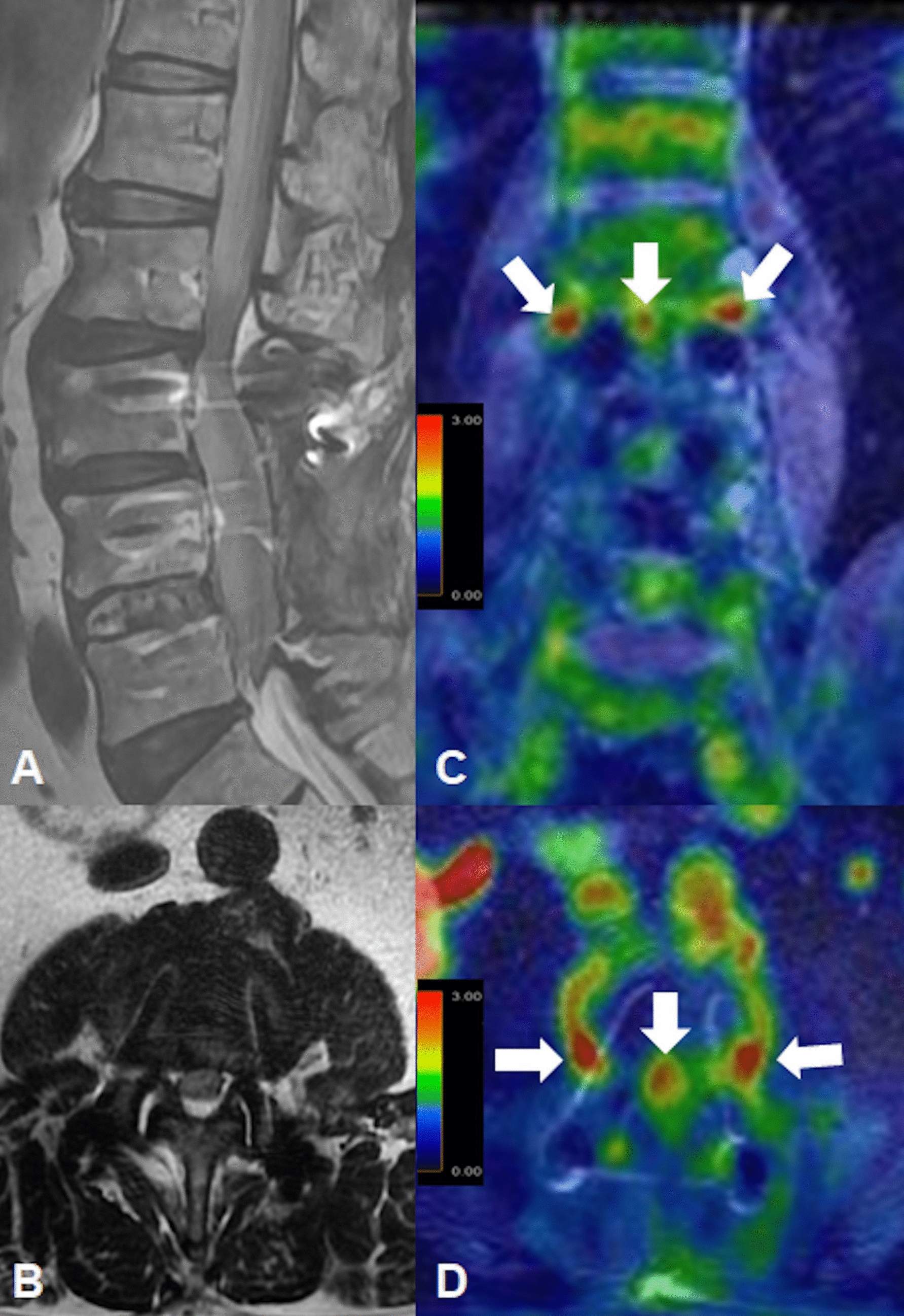 Added value of 18Fluorine-fluorodeoxyglucose (18F-FDG) PET/MRI for evaluation of failed back surgery syndrome: comparison with non-contrast MRI