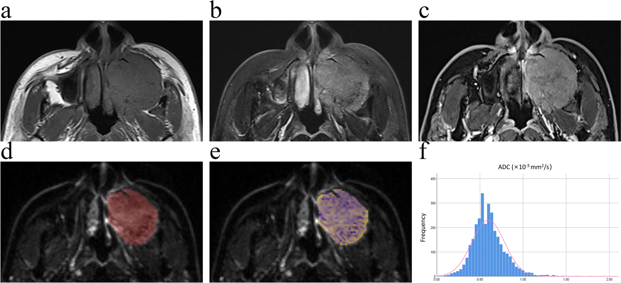 Sinonasal adenoid cystic carcinoma: preoperative apparent diffusion coefficient histogram analysis in prediction of prognosis and Ki-67 proliferation status