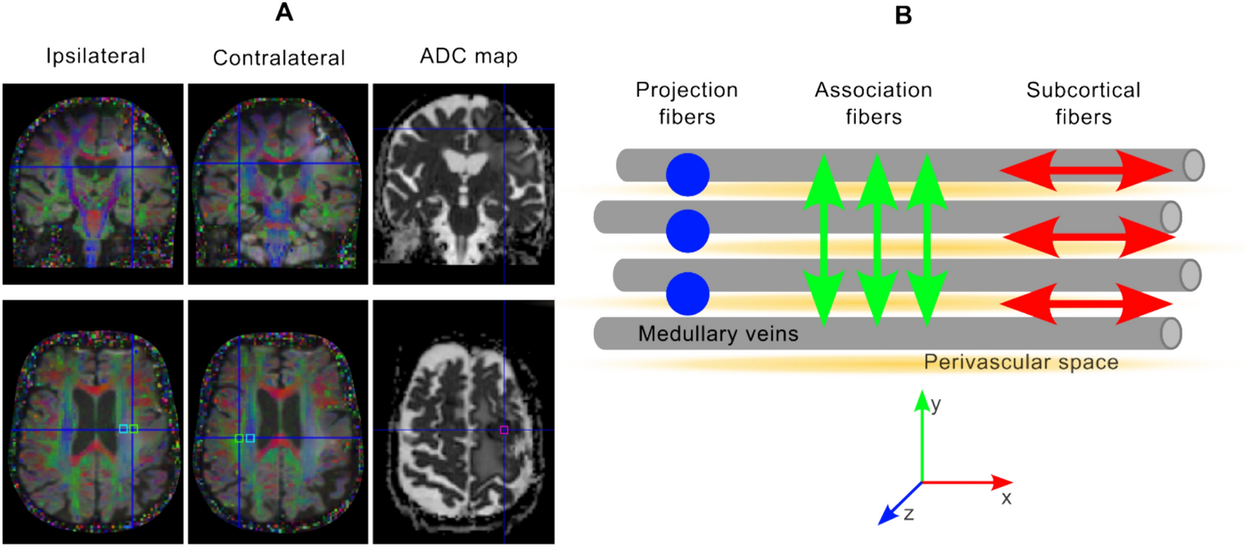 Evaluating the glymphatic system via magnetic resonance diffusion tensor imaging along the perivascular spaces in brain tumor patients