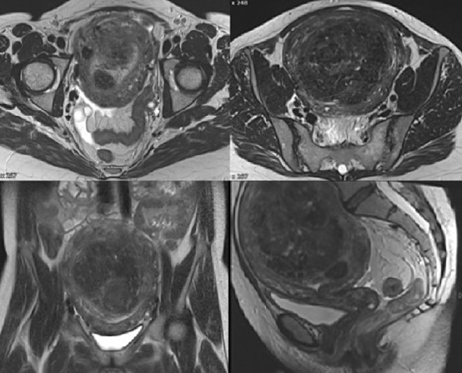 Very pronounced bowel sparing during radiation therapy for anal carcinoma using a natural spacer (Myoma) – a case report