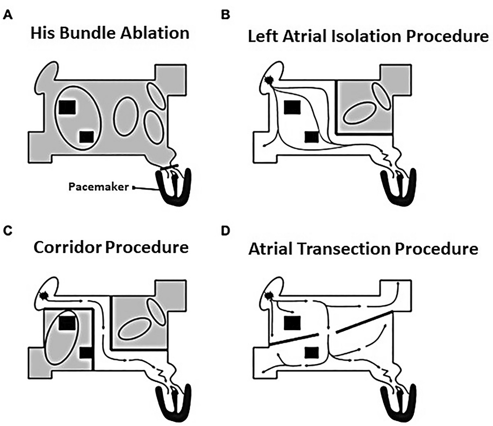 Narrative Review: Surgical and Hybrid Management of Atrial Fibrillation