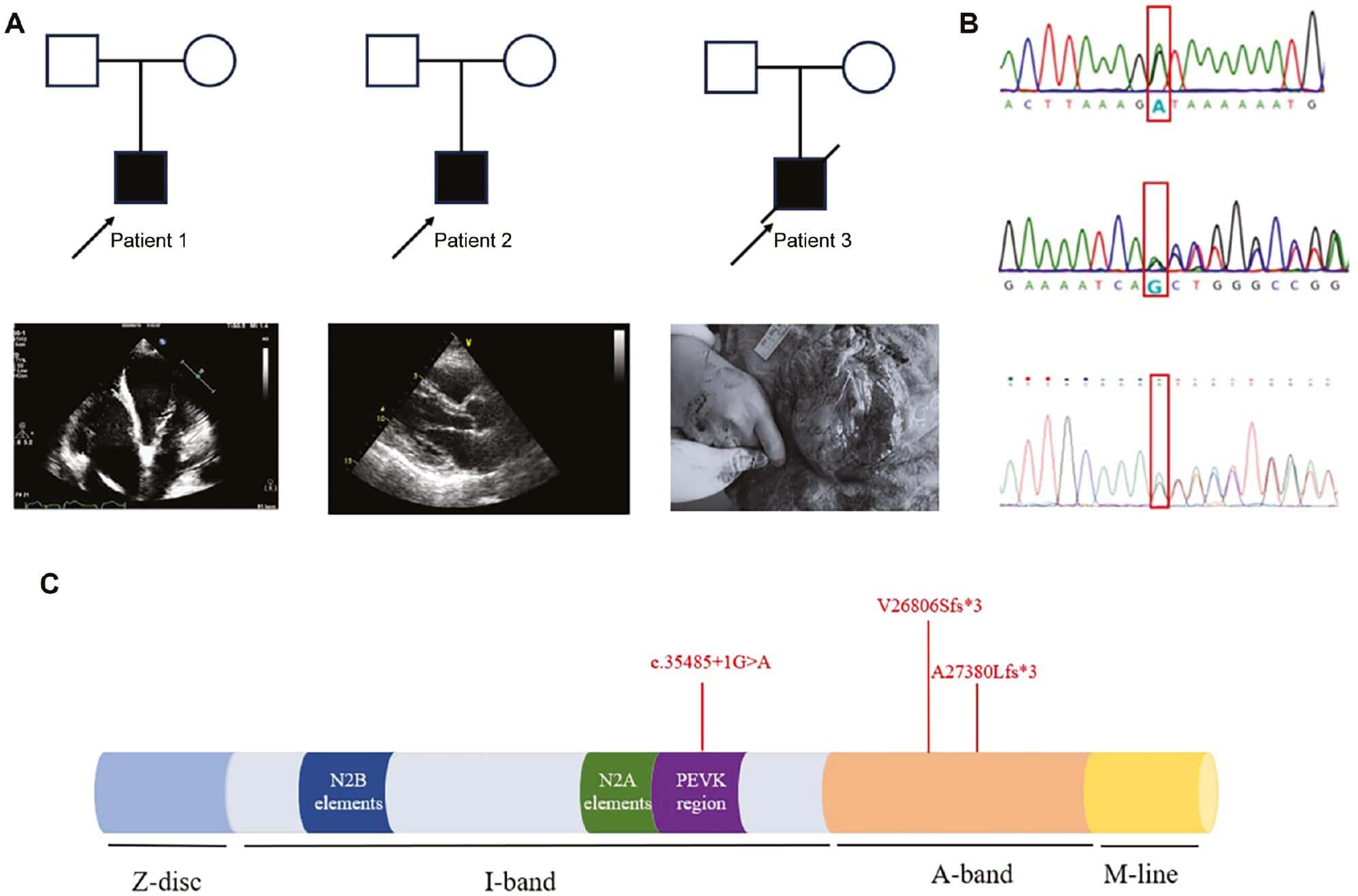 Whole-Exome Sequencing Identifies Three Novel TTN Variants in Chinese Families with Dilated Cardiomyopathy