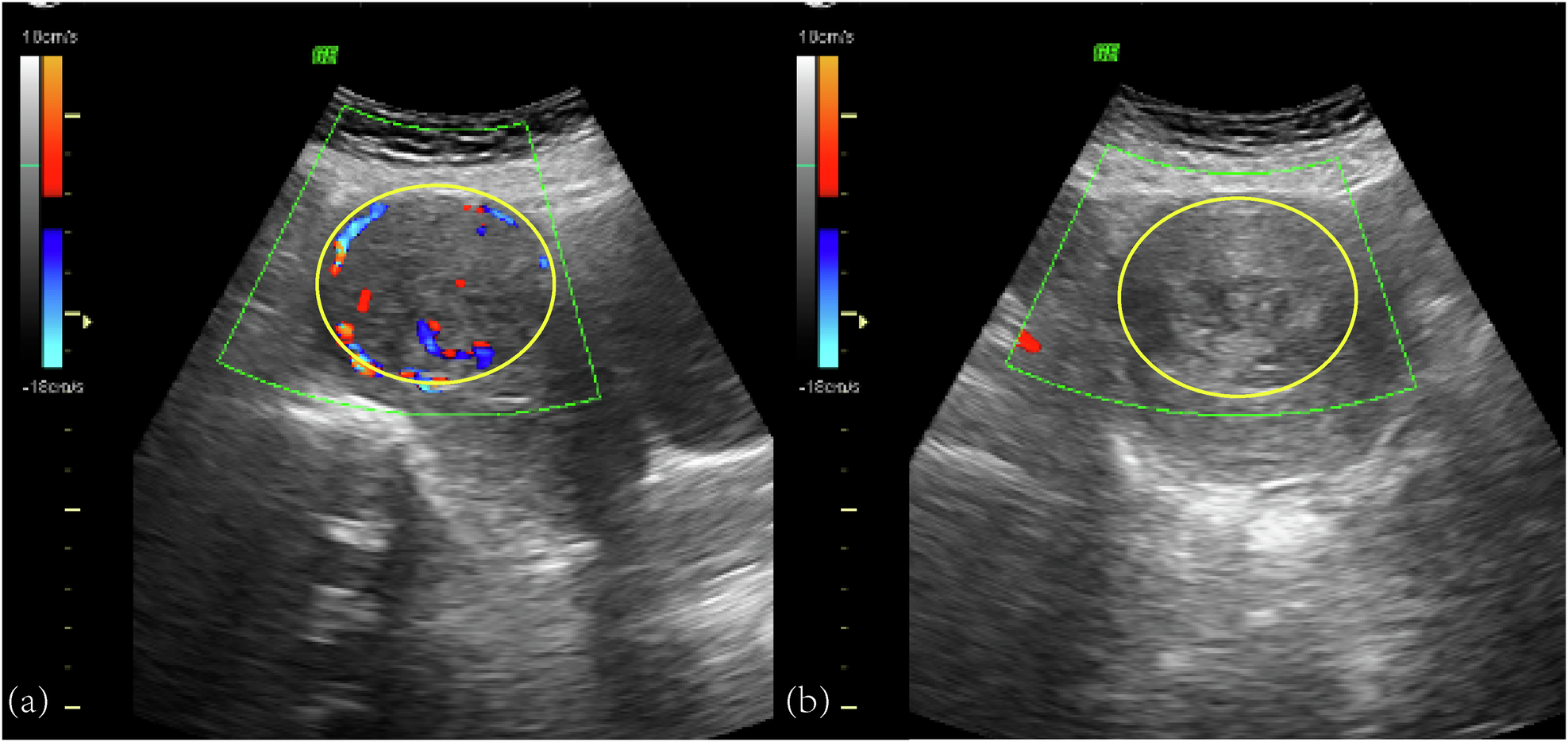 Letter to the Editor: “What predicts durable symptom relief of uterine fibroids treated with MRI-guided focused ultrasound? A multicenter trial in 8 academic centers”