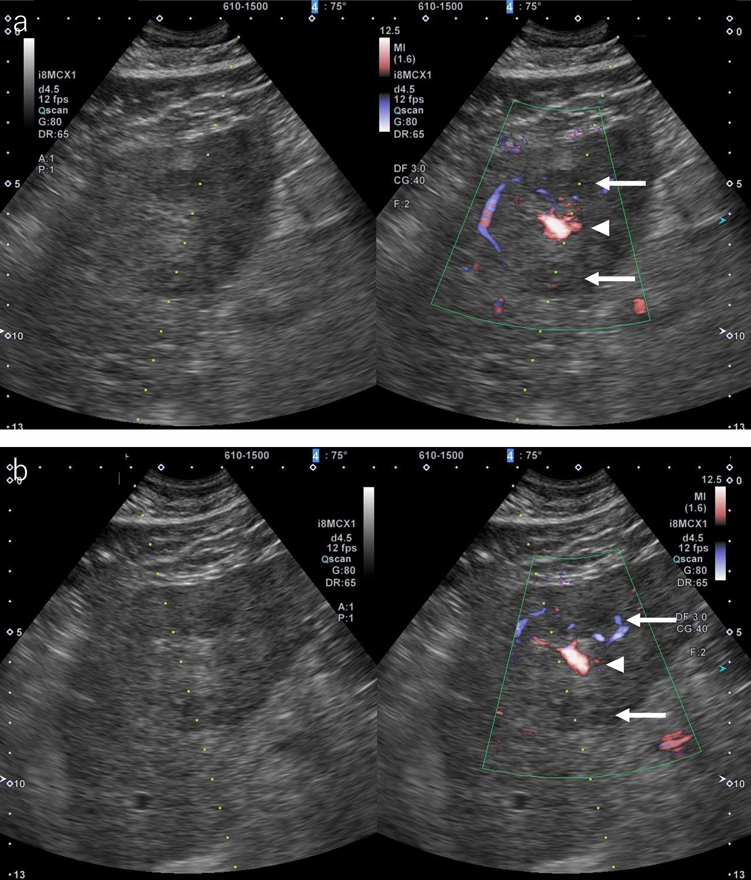 Ablation manual for liver cancer