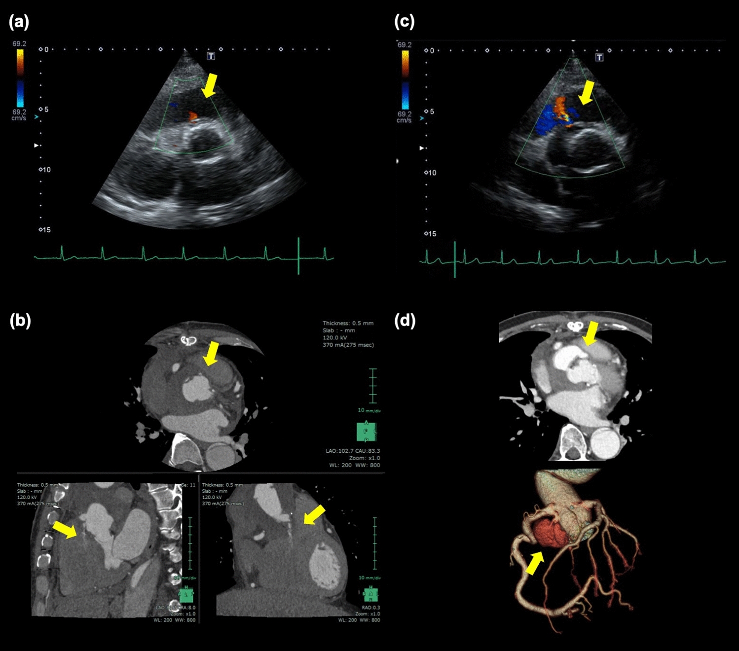 Coronary button pseudoaneurysm following valve-sparing aortic root replacement