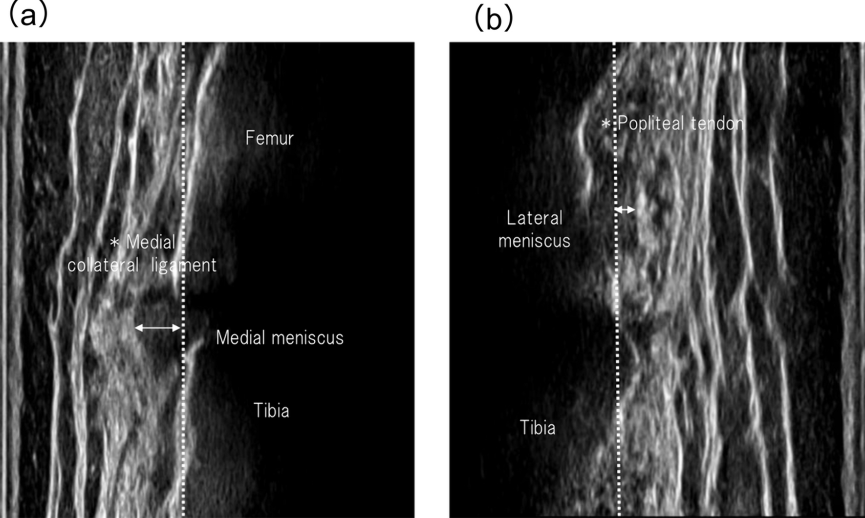 Evaluation under loading detects medial meniscus extrusion in patients with reconstructed anterior cruciate ligament and restricted knee extension