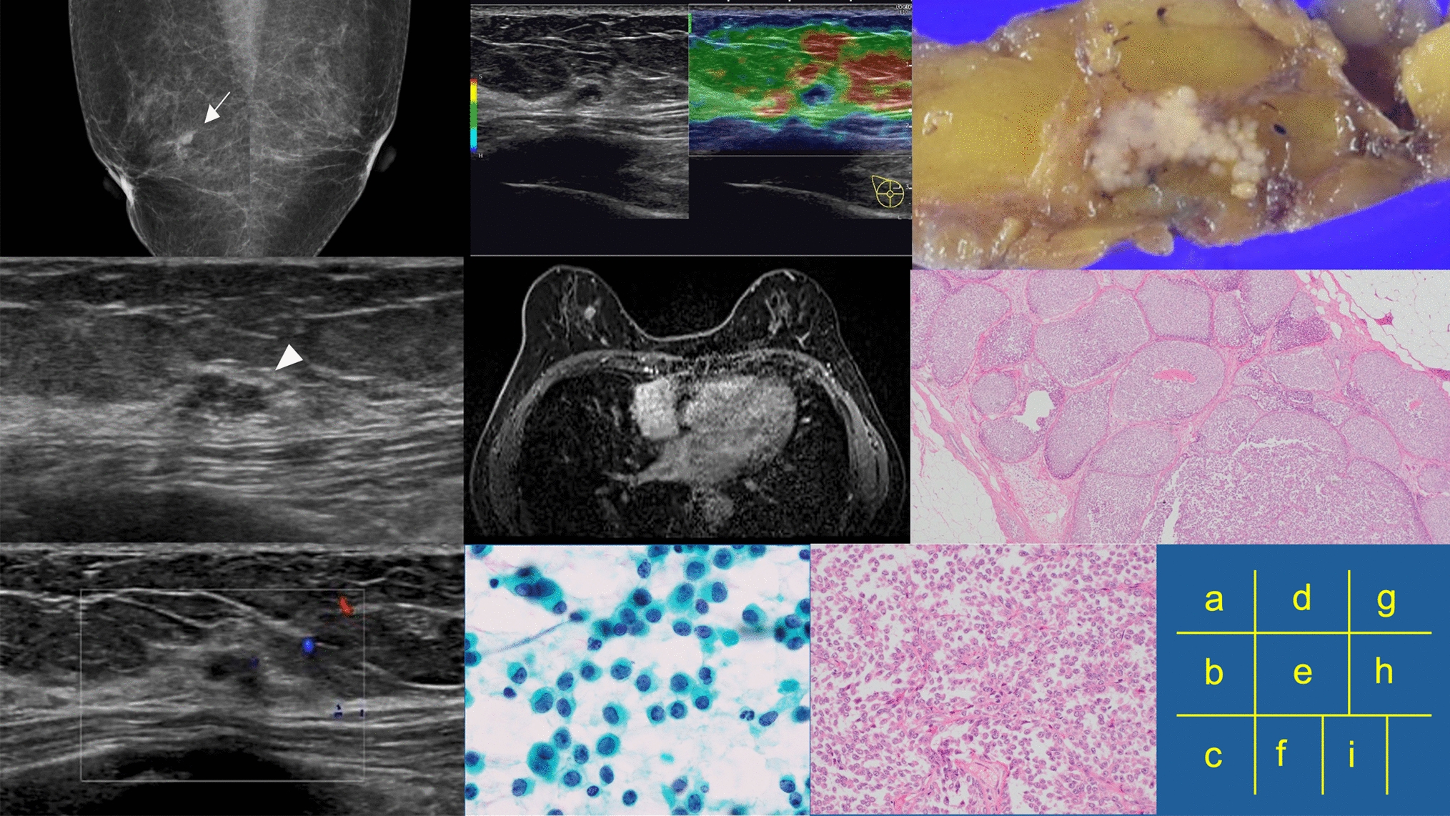 Lobular carcinoma in situ detectable as a mass on ultrasonography: a case report
