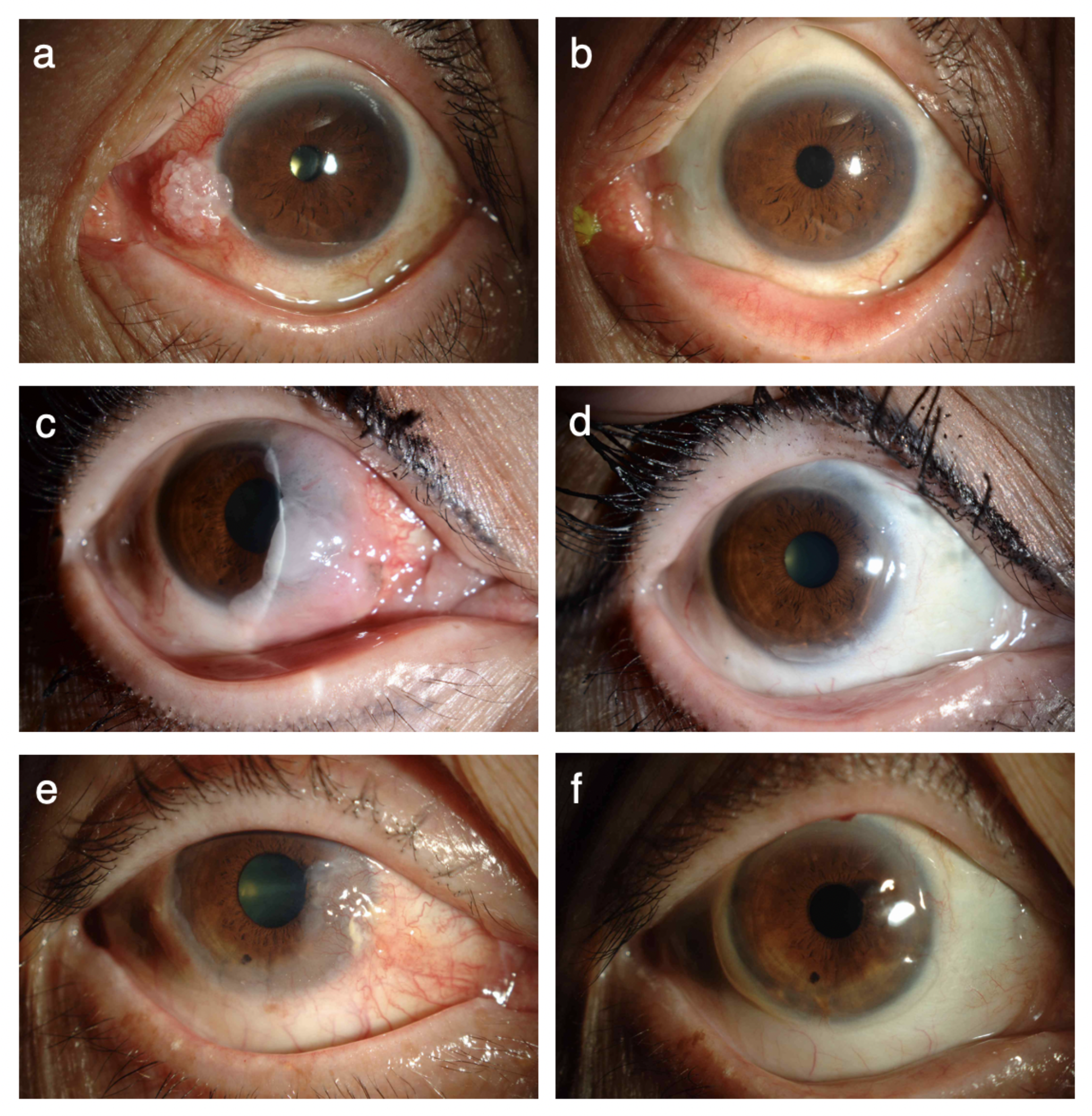 Excision combined with ocular surface reconstruction followed by topical chemotherapy for ocular surface squamous neoplasia