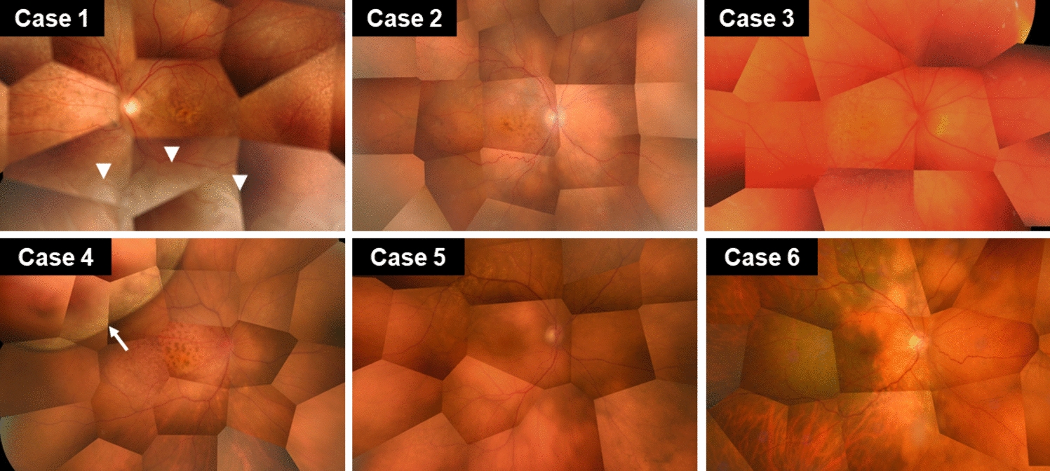 Clinical features and multimodal imaging of primary choroidal lymphoma
