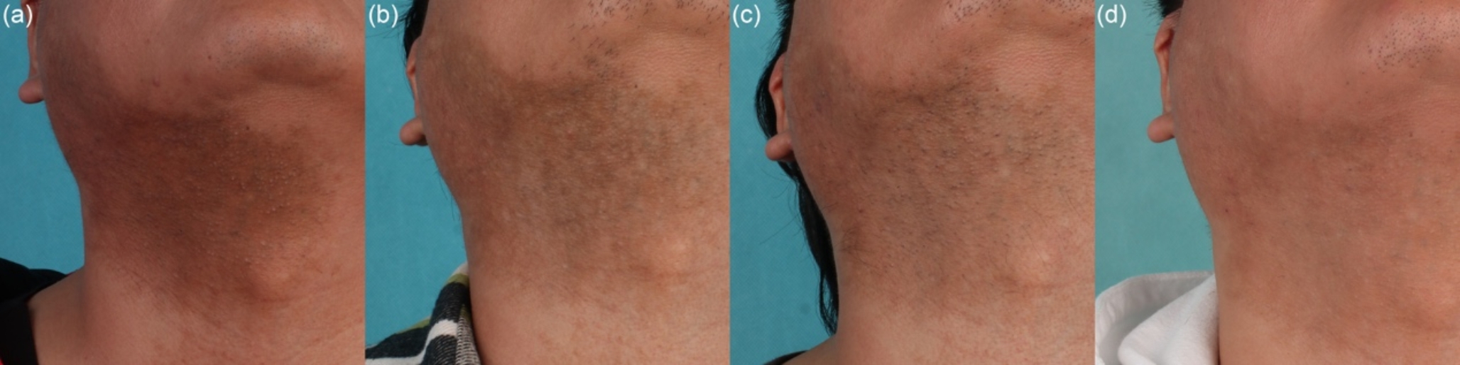Successful treatment of challenging Becker’s Nevus with continuous low-fluence Q-switched Nd: YAG 1064 nm laser and long-pulsed Nd: YAG 1064 nm laser