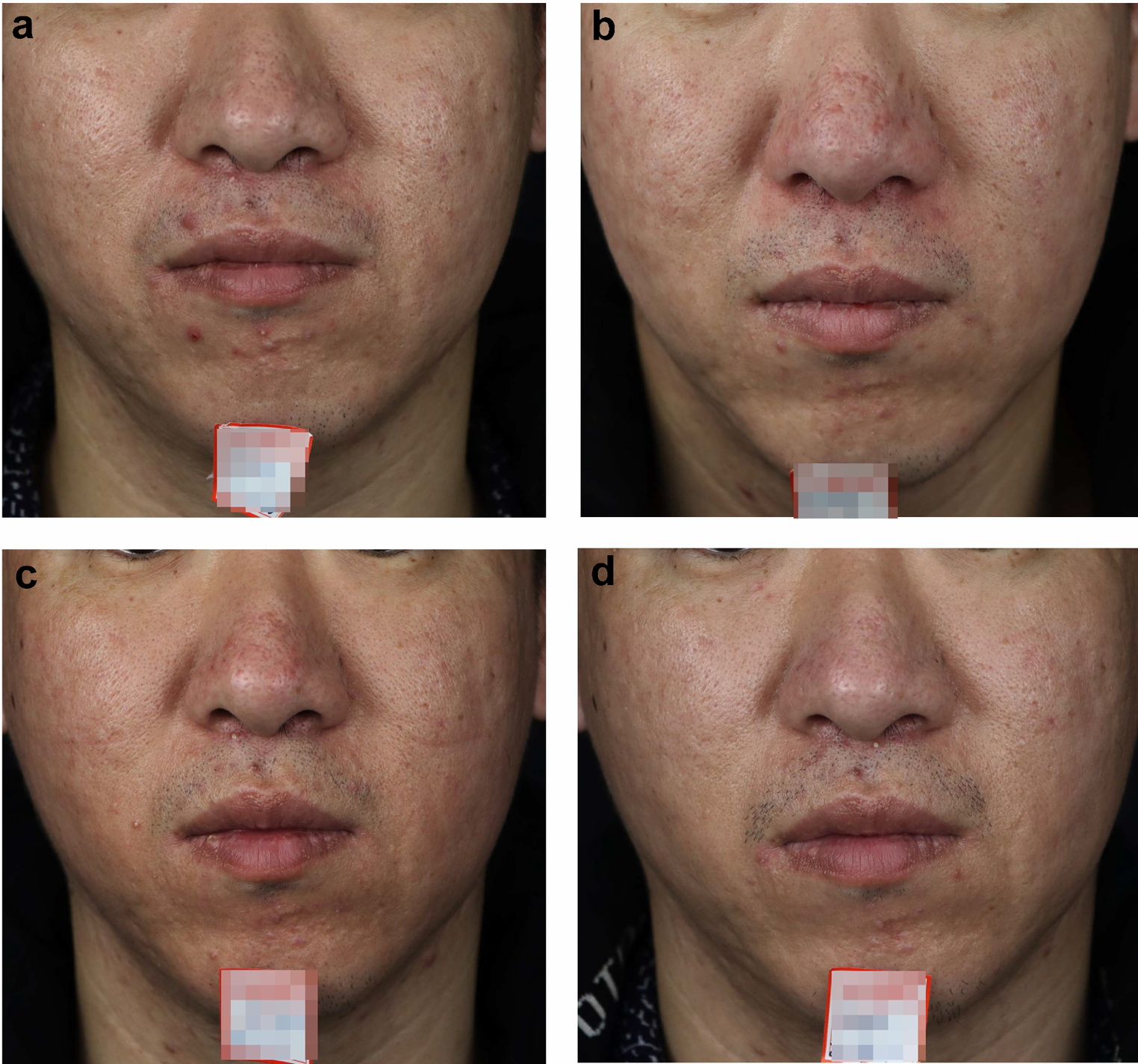 Efficacy and adverse reactions of fractional CO2 lasers for treating papular acne scars: a retrospective study of 35 patients