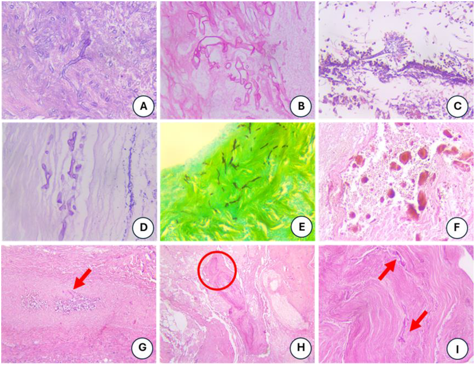Invasive Fungal Rhinosinusitis: The First Histopathological Study in Vietnam