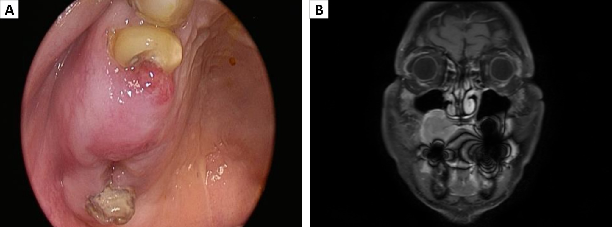 Primary Mast Cell Sarcoma of the Maxillary Sinus and Gingiva Mimicking Malignant Neuroendocrine Tumor: A Case Report