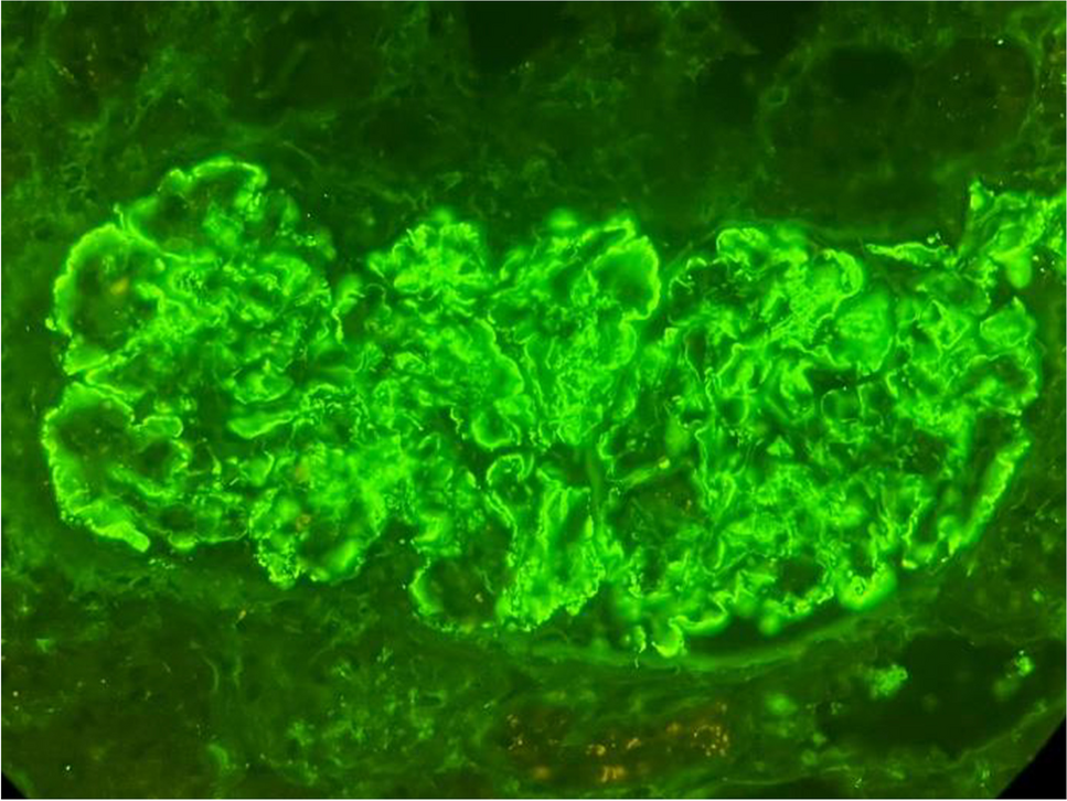 Proliferative glomerulonephritis with monoclonal IgG deposits in an adolescent successfully treated with daratumumab