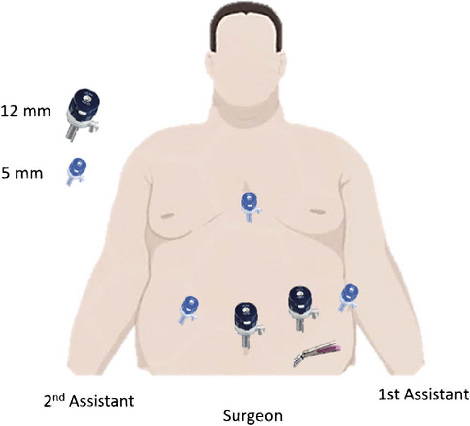 The Role of ICG During the SADI-S Procedure
