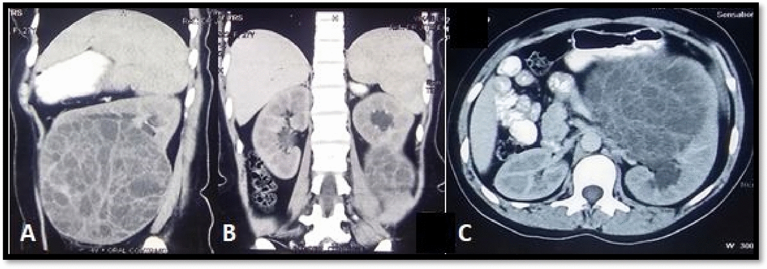 Multilocular cystic nephroma in an adult: a diagnostic quandary