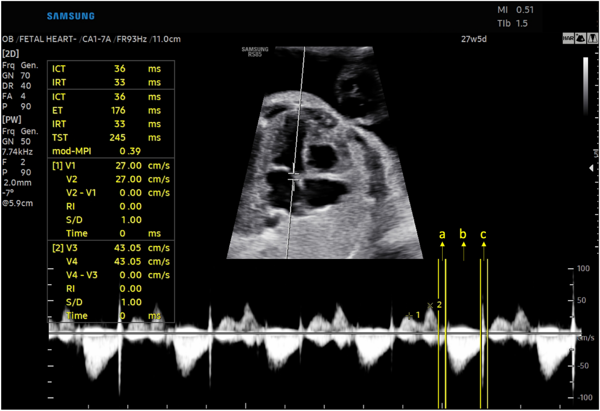 Is It Diabetes or Just Macrosomia? Fetal Myocardial Performance Index in Large-for-Gestational Age Fetuses