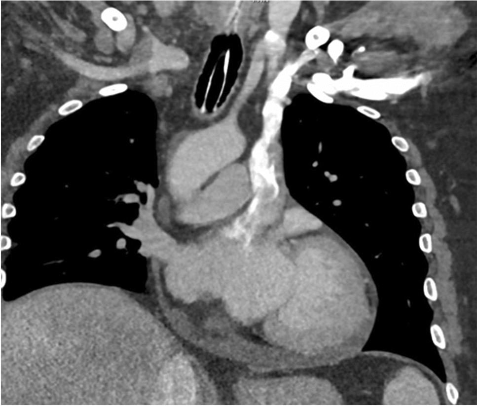 Left Superior Vena Cava Draining to Left Atrium: A Case Report, Review of the Literature, and Classification
