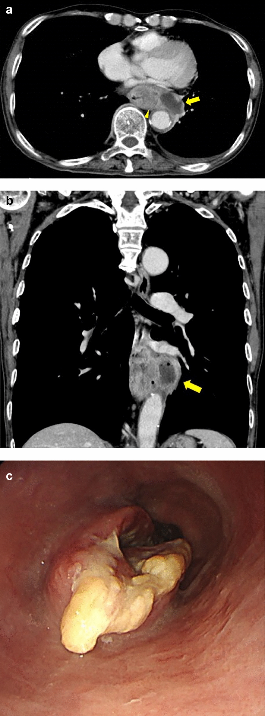 Endoscopic ultrasound-guided drainage for mediastinal abscess: first report of bridge to surgery for esophageal cancer