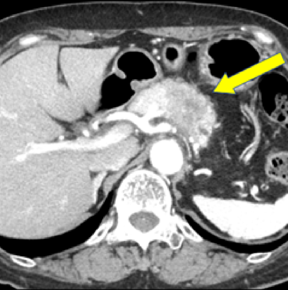 A case of MSI-high pancreatic body-tail cancer successfully treated with radical resection after pembrolizumab