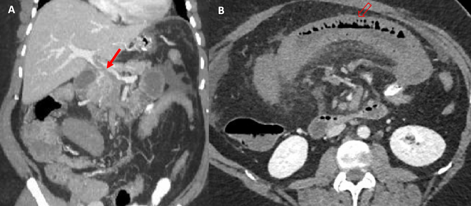 Thrombotic complications following bariatric surgery: how medical tourism poses challenges to comprehensive care in obesity medicine