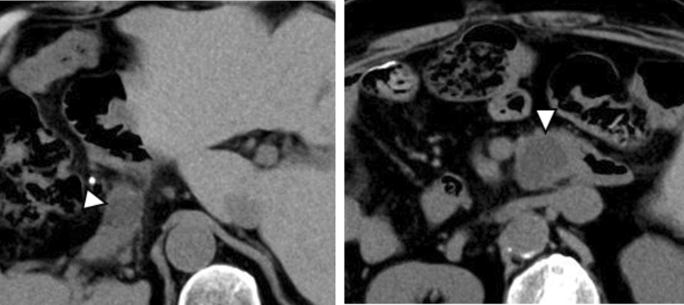 A case of situs inversus totalis with hemosuccus pancreaticus due to intrapancreatic pseudocyst perforation of the common hepatic artery treated with a vascular stent graft