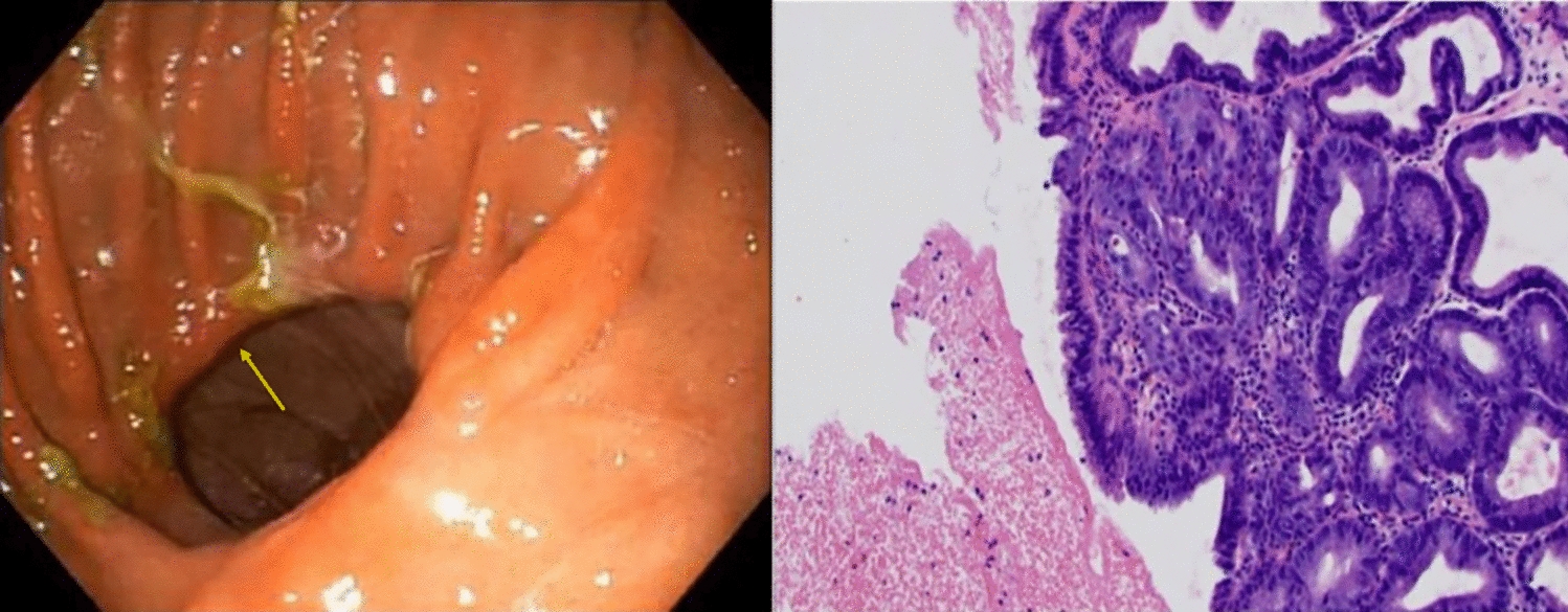 Tubular adenoma at the hepatico-jejunal anastomosis in familial adenomatous polyposis (FAP) following pancreaticoduodenectomy: challenges in adenoma surveillance and management
