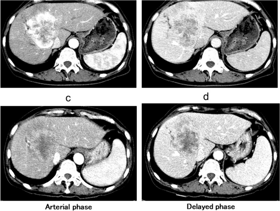 A case of immune checkpoint inhibitor-associated hemophagocytosis after initiation of atezolizumab plus bevacizumab therapy for advanced hepatocellular carcinoma