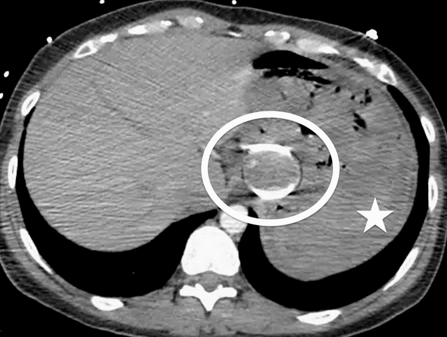 Gastric band removal: mind the arterial anastomoses!