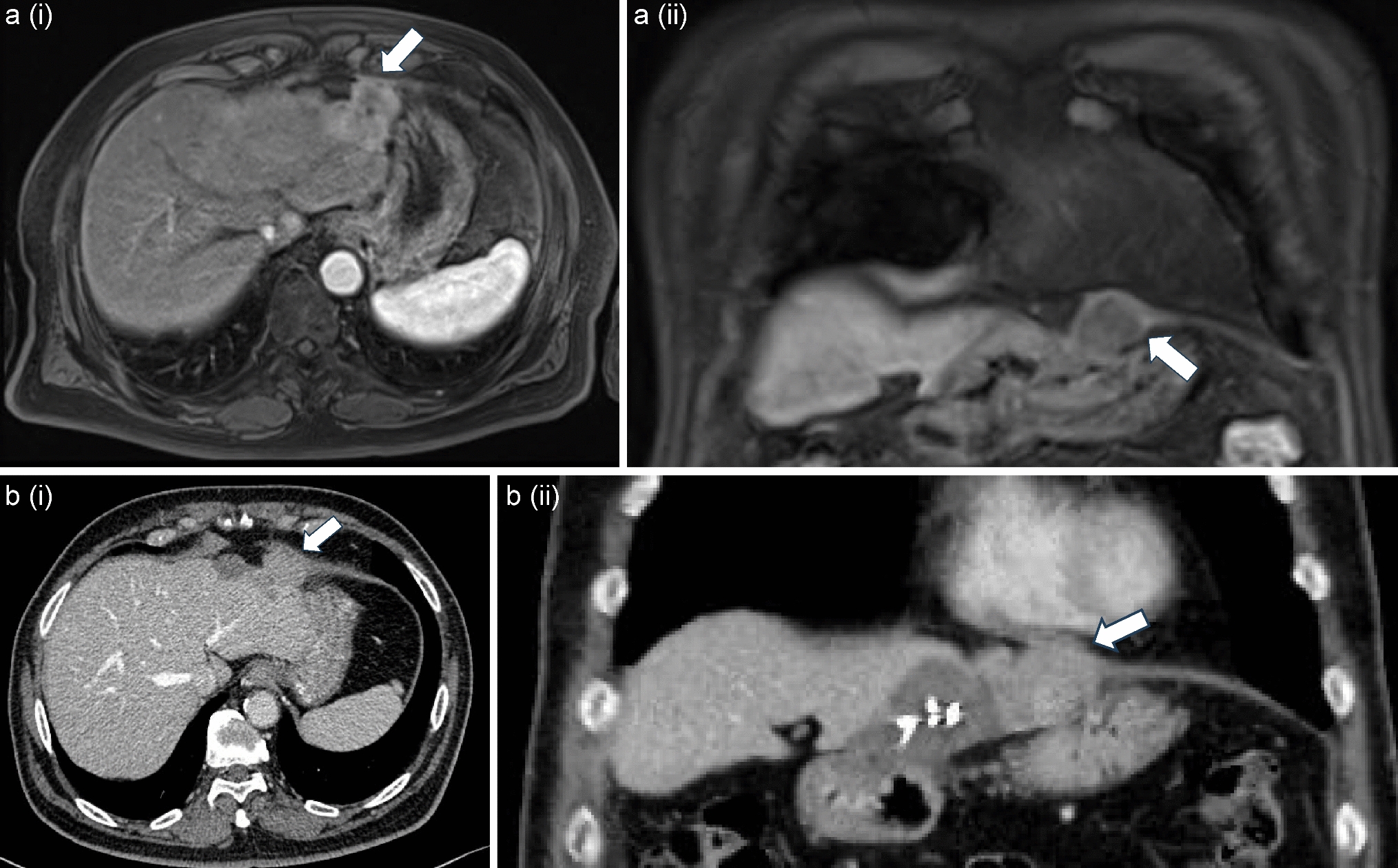 Diaphragmatic and pericardial reconstruction using a Gore-Tex® patch in a patient with an invasive liver malignancy