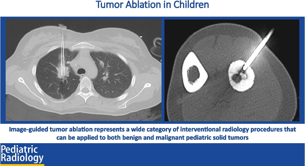 Tumor ablation in children