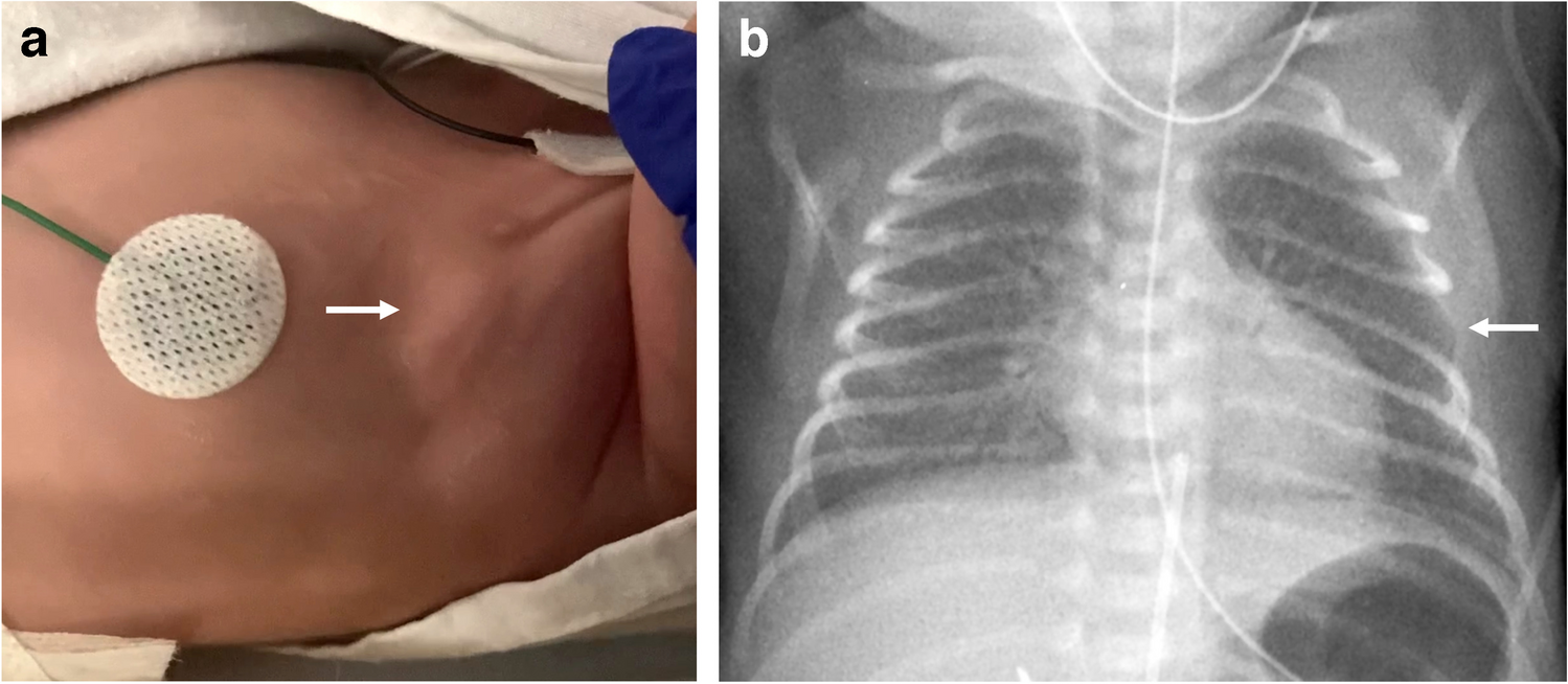 Congenital intercostal lung herniation